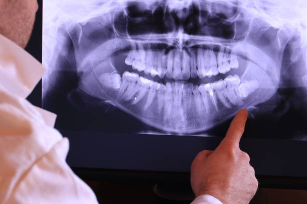 Best Emergency Tooth Extraction in Frederickson, WA