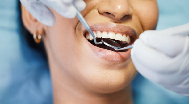 Best Emergency Wisdom Teeth Removal in Frederickson, WA