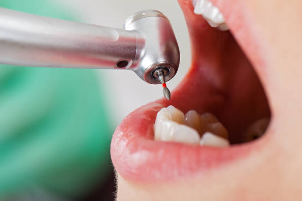 Best Emergency Tooth Extraction in Frederickson, WA